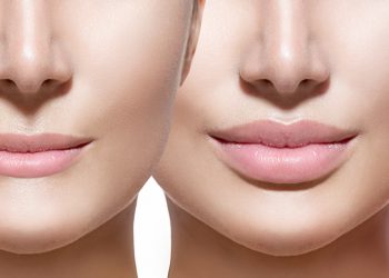 Before and after lip filler injections. Lips closeup over white